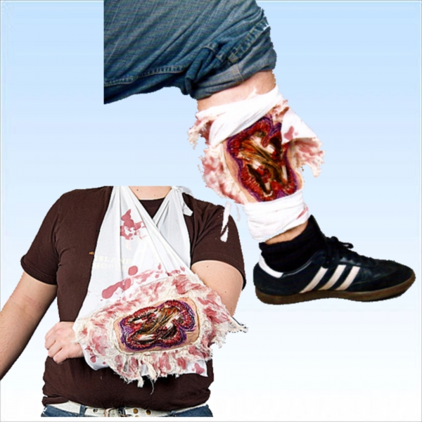 Offener Bruch mit Verband